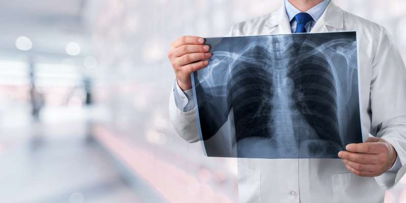 Akciğer Kanserinin Belirtileri ve Tedavi Yöntemleri Nelerdir?