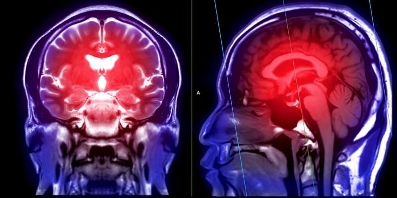 Beyin Kisti Nedir? Beyin Kistinin Belirtileri Nelerdir? Beyin Kisti Tedavisi Nasıl Yapılır?